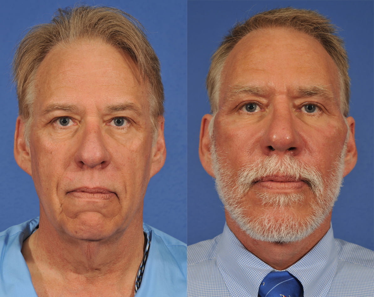 Rhinoplasty and Facelift Before & After #1