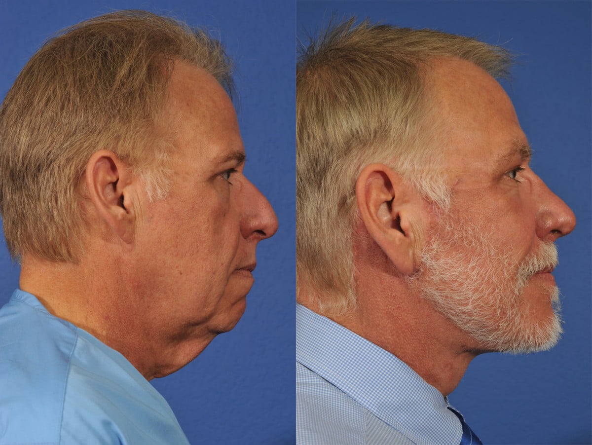 Rhinoplasty and Facelift Before & After #1