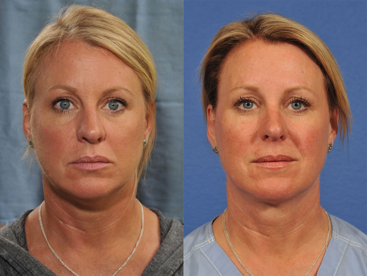 Kybella Before & After #2 image 3