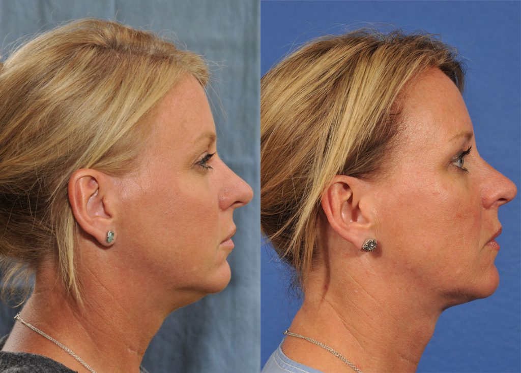 Kybella Before & After #2