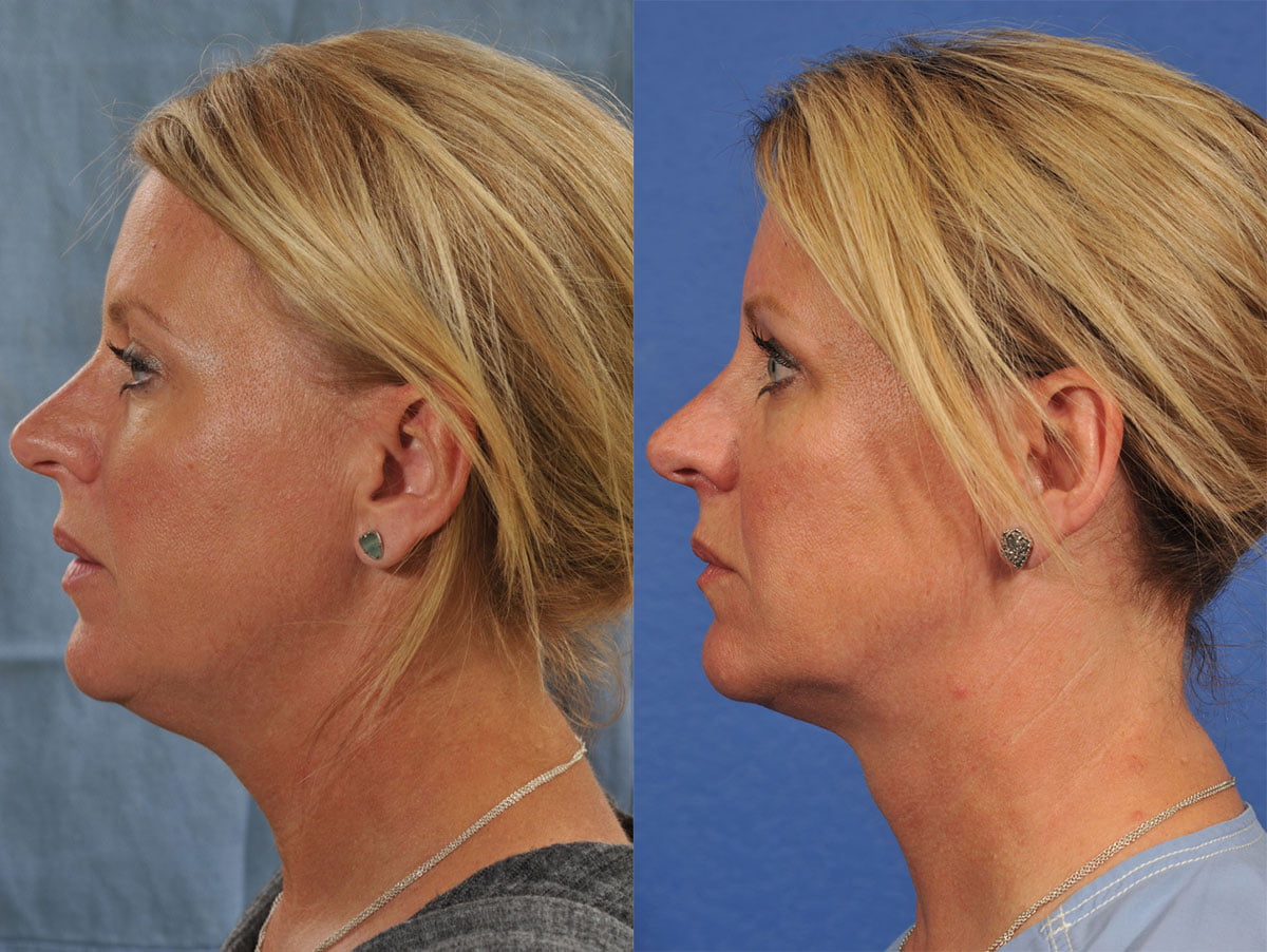 Kybella Before & After #2