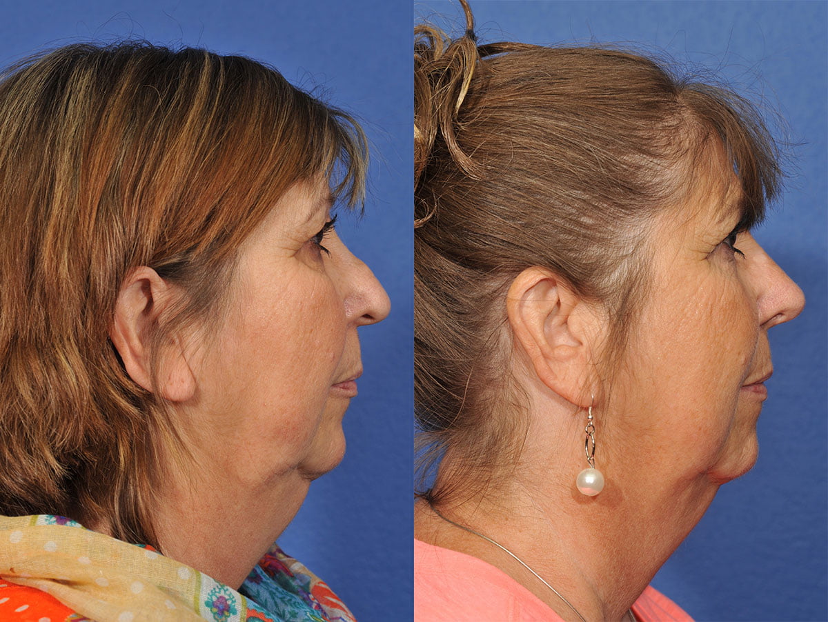 Revision Rhinoplasty Before & After #1