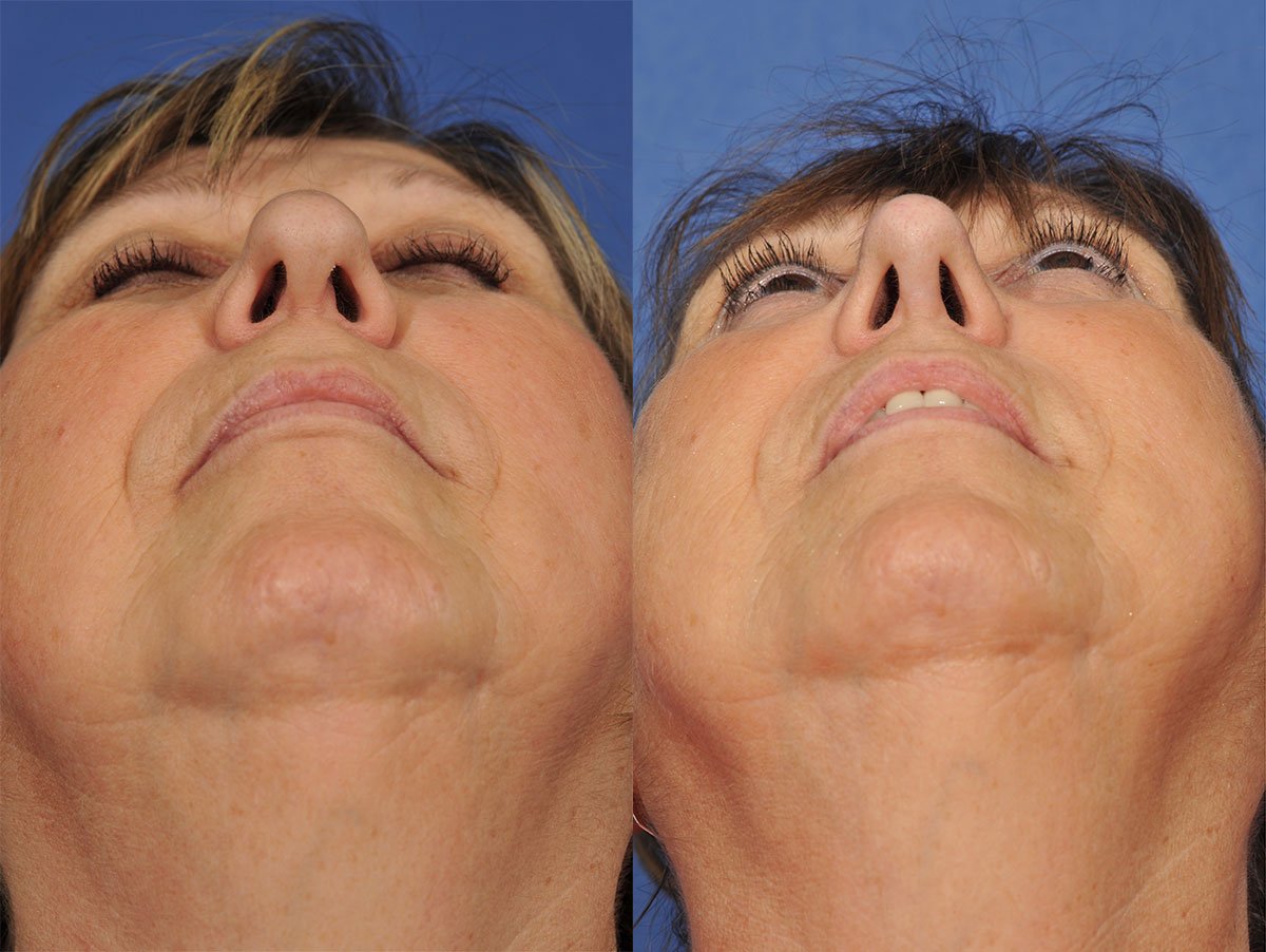 Revision Rhinoplasty Before & After #1 image 2