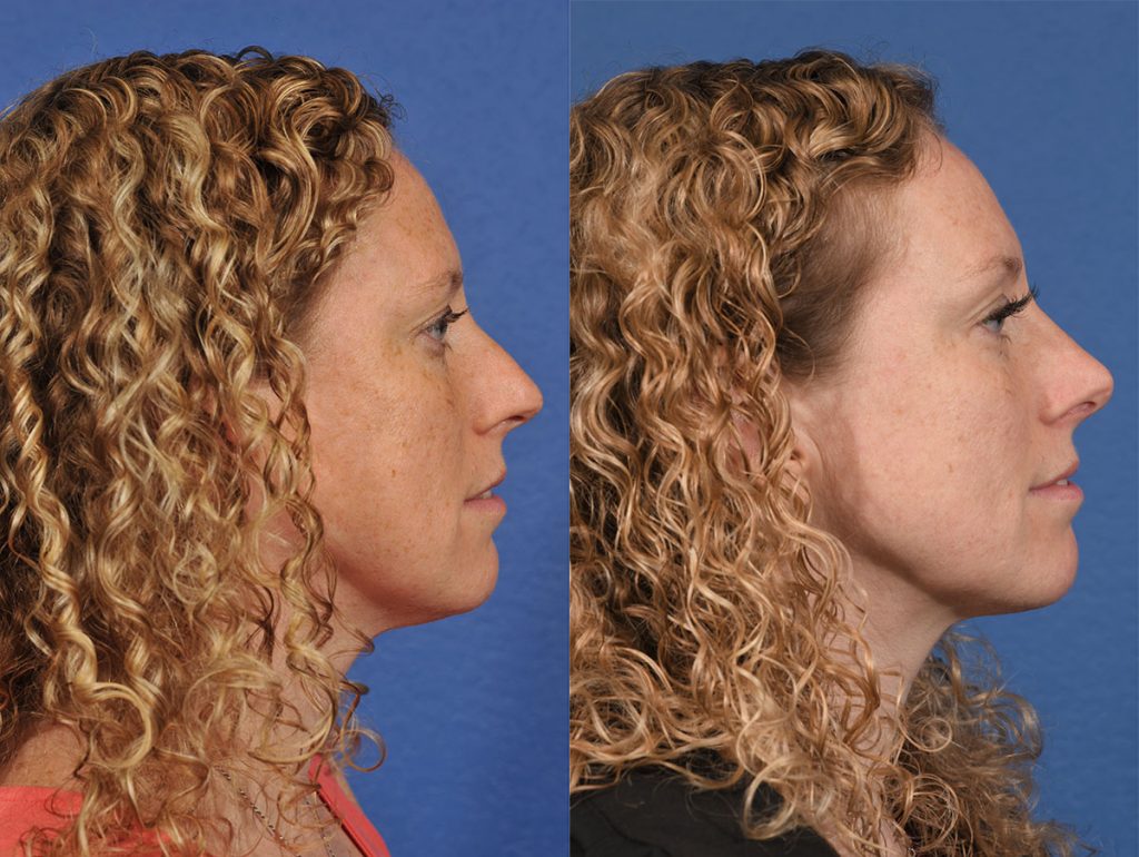 Rhinoplasty Before & After #10 before and after