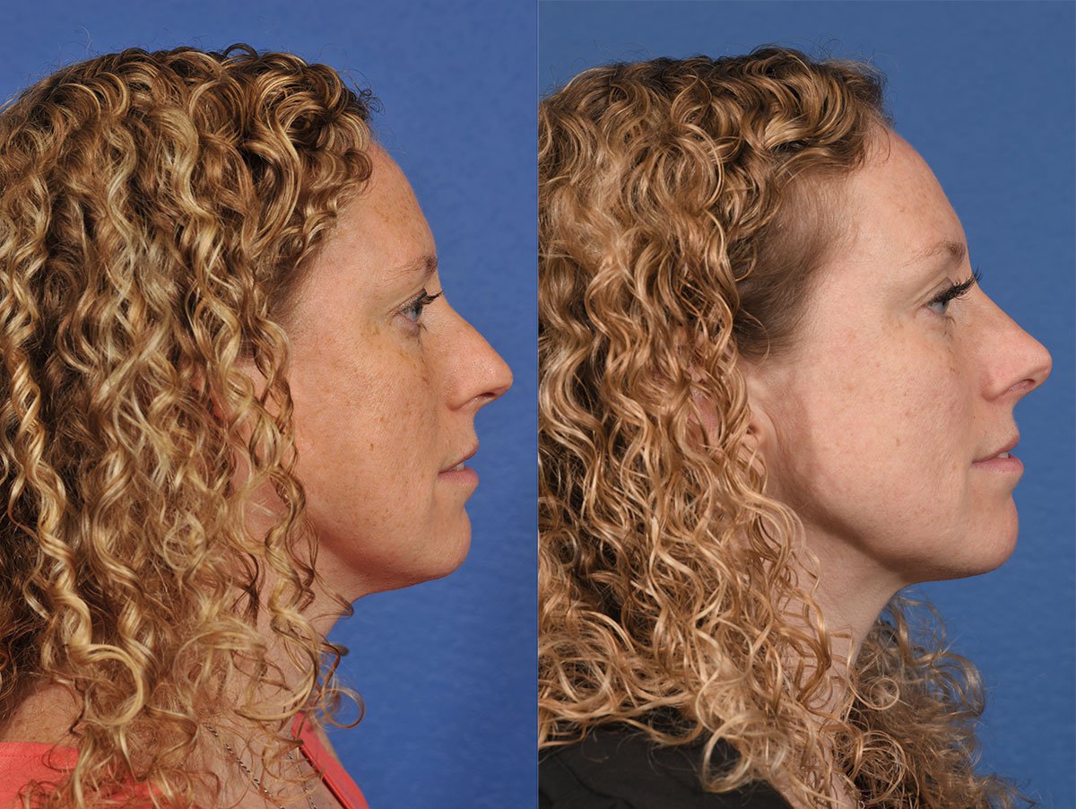 Rhinoplasty Before & After #10