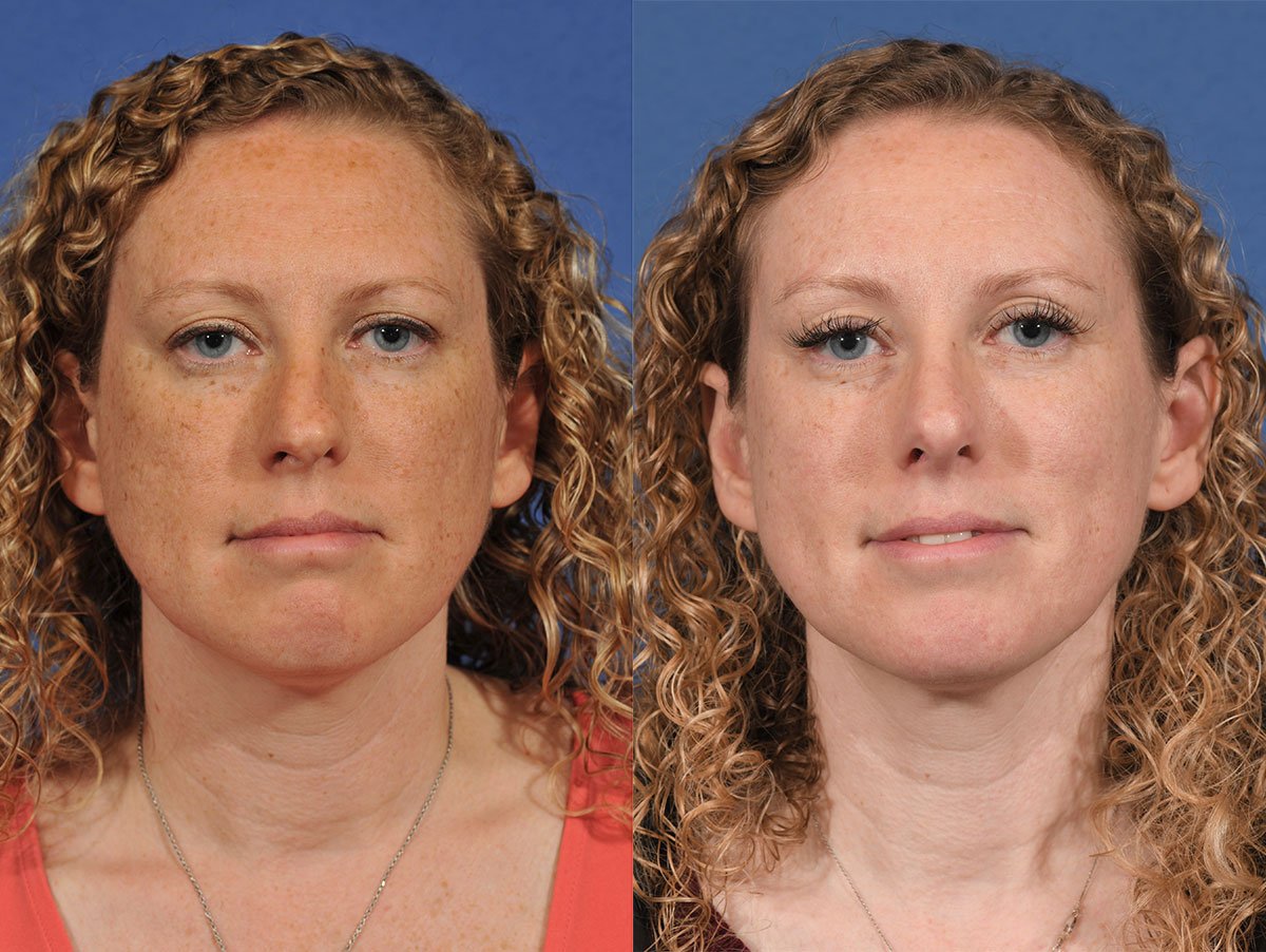 Rhinoplasty Before & After #10 image 2