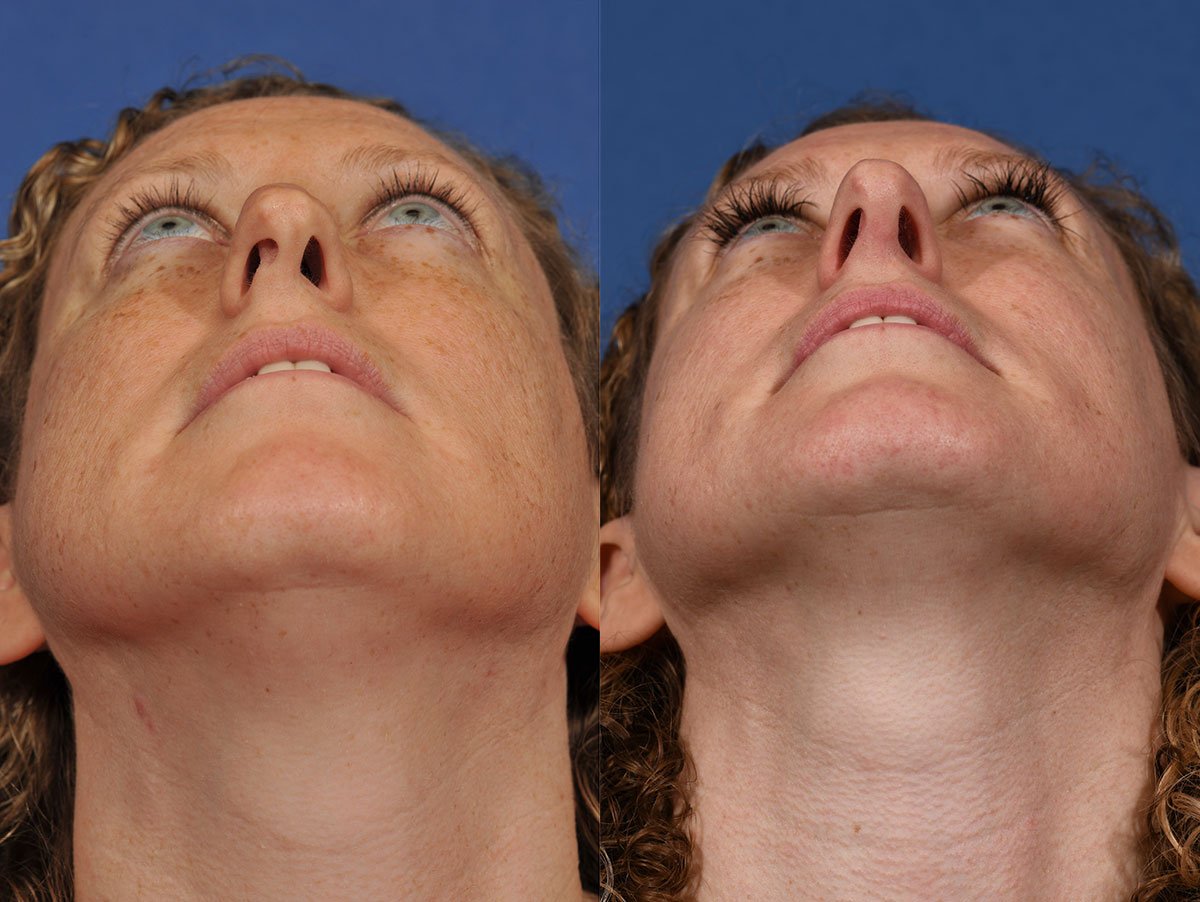 Rhinoplasty Before & After #10 image 3