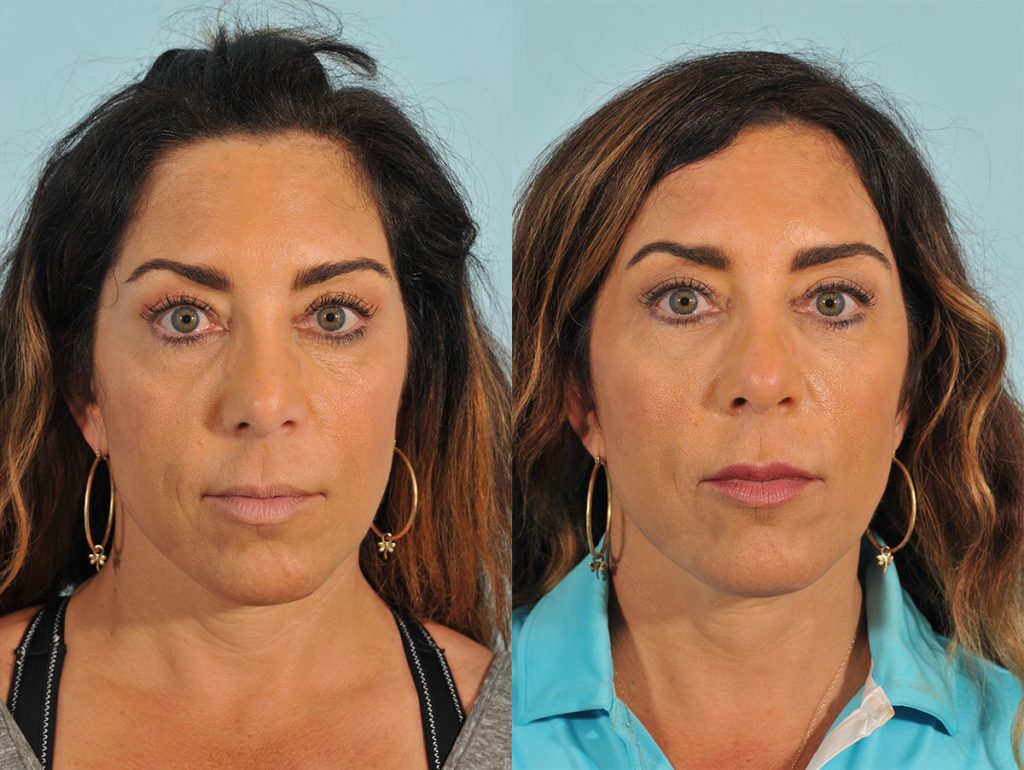 Injectables Before & After #4