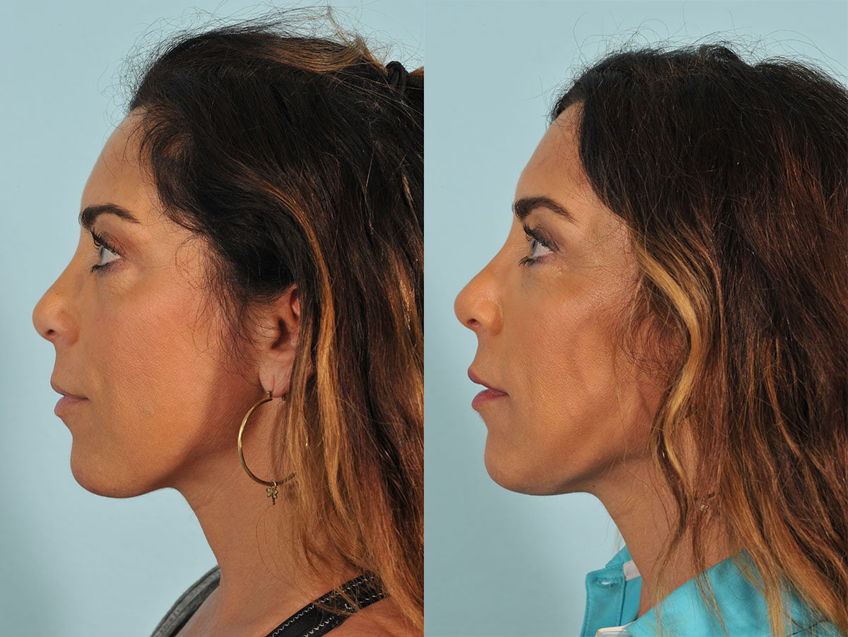 Injectables Before & After #4