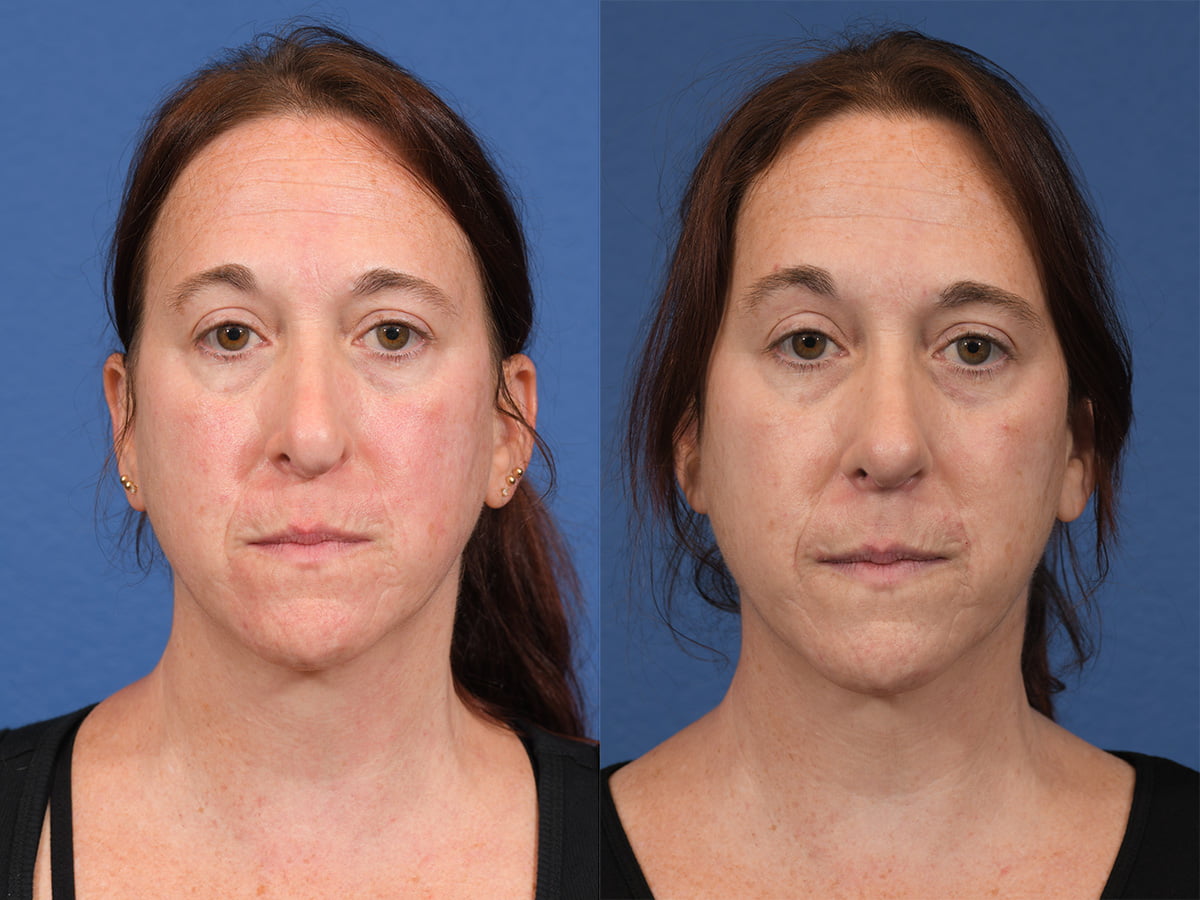 Rhinoplasty Before & After #11 image 1