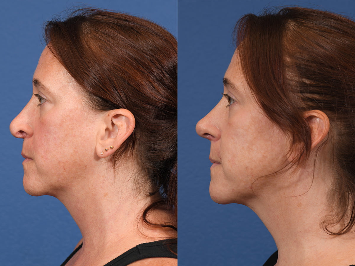 Rhinoplasty Before & After #11 image 2