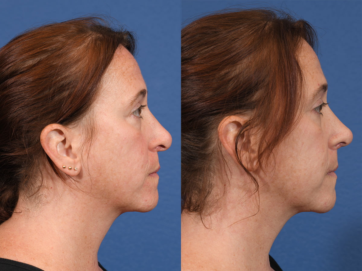 Rhinoplasty Before & After #11