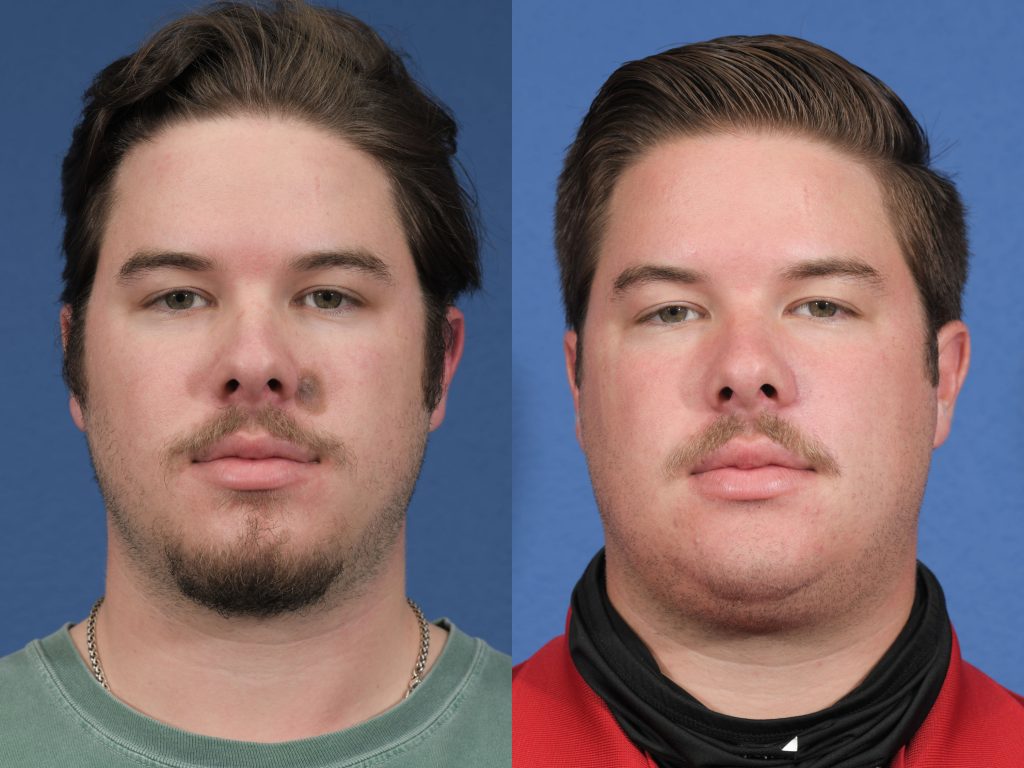 Reconstruction Before & After #1