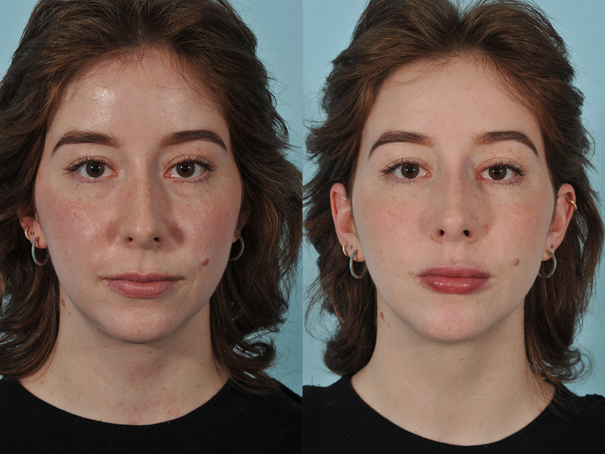 Injectables Before & After #5
