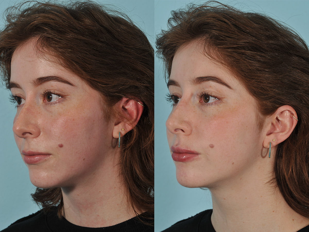 Injectables Before & After #5 image 2