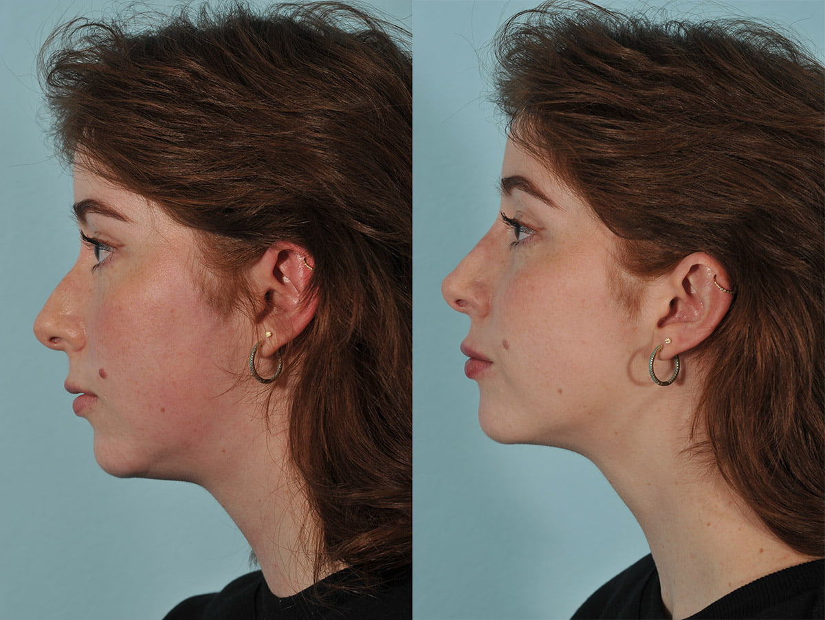 Injectables Before & After #5 image 3