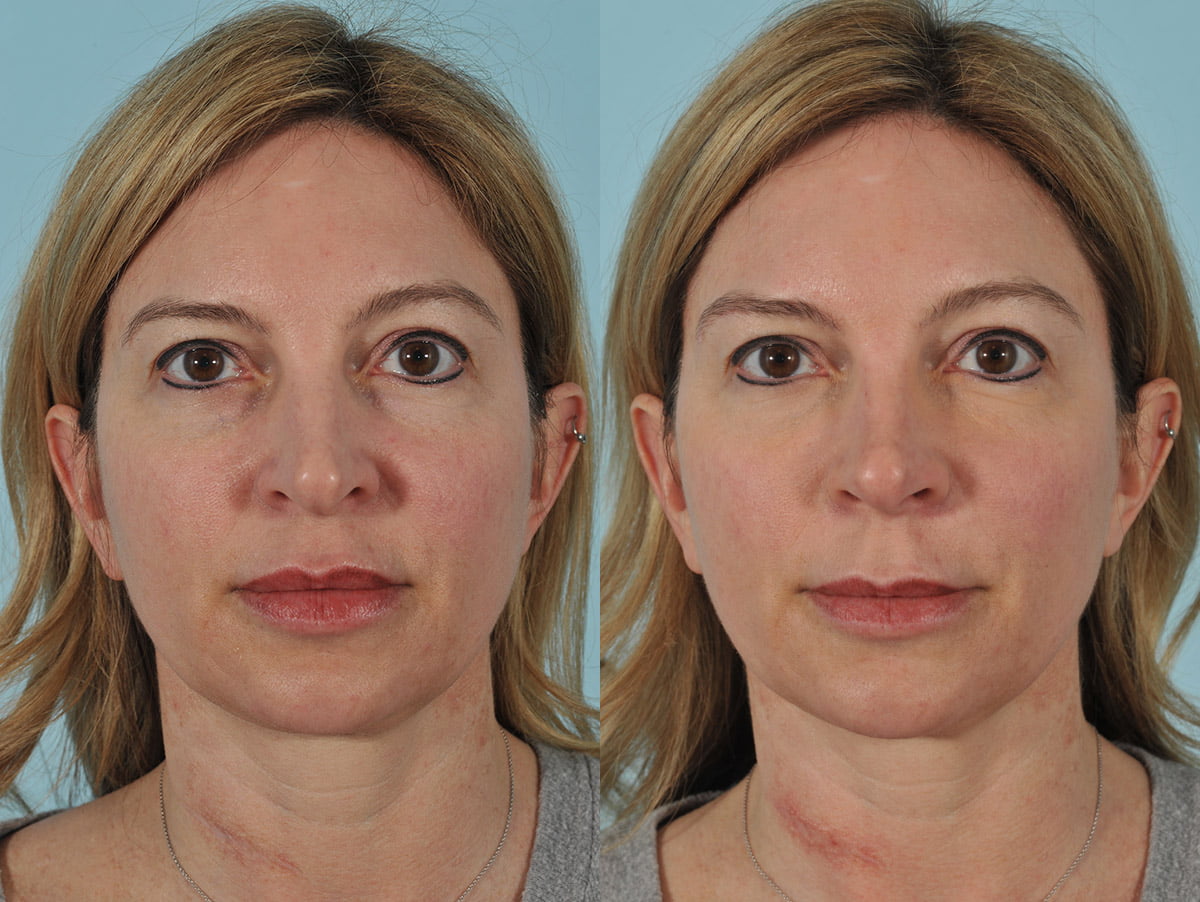 Injectables Before & After #6