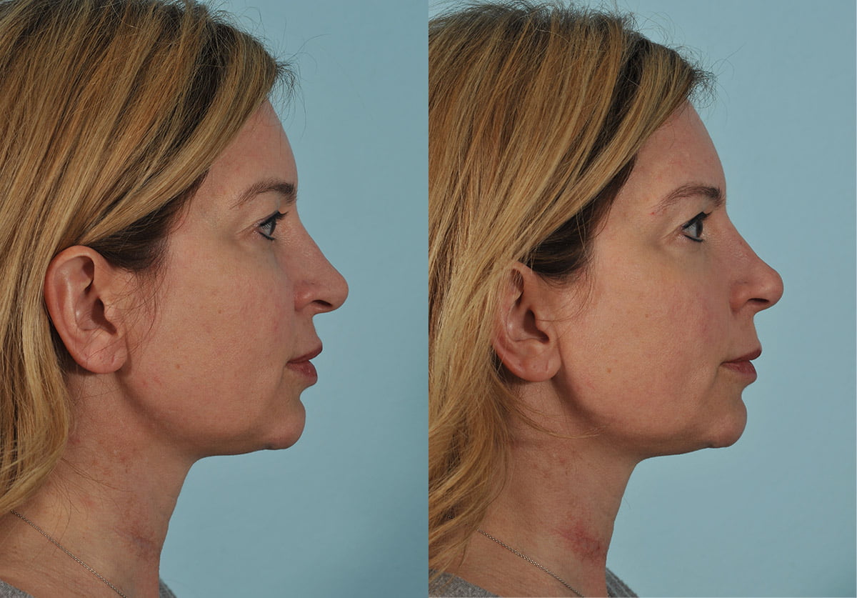 Injectables Before & After #6 image 2
