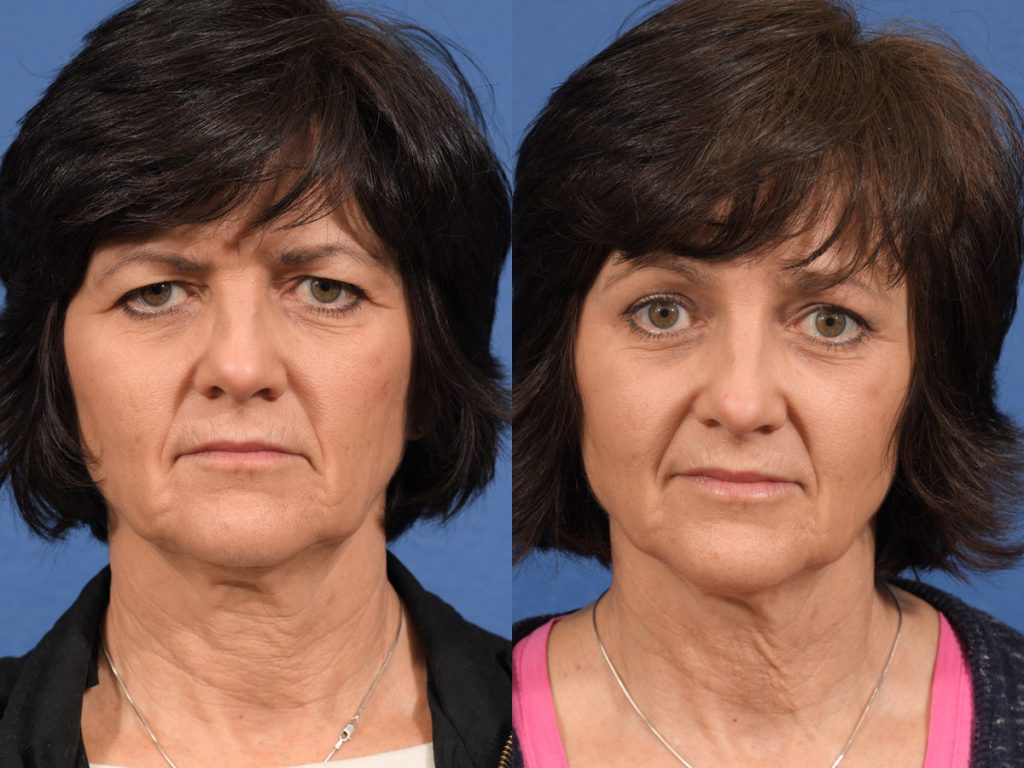 Blepharoplasty Before & After #2