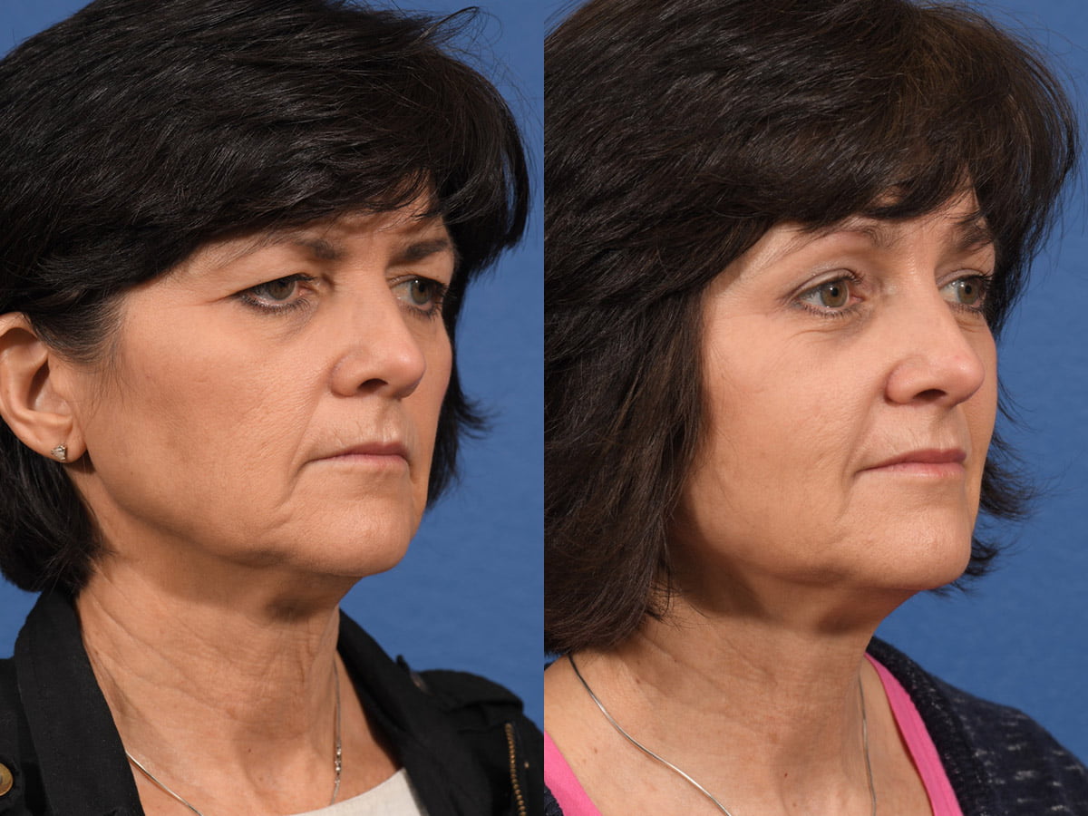 Blepharoplasty Before & After #2 image 2