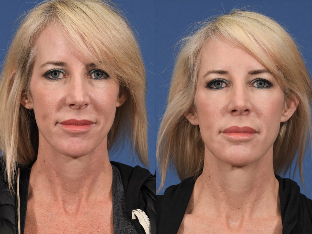 Injectables Before & After #7