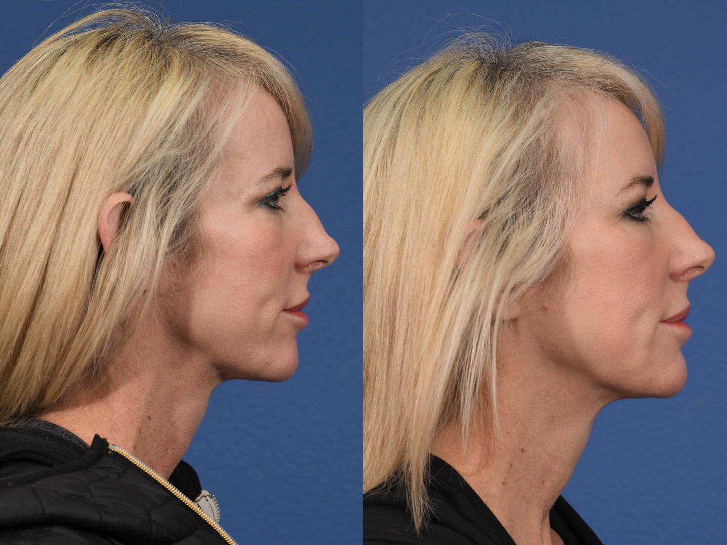 Injectables Before & After #7 image 2