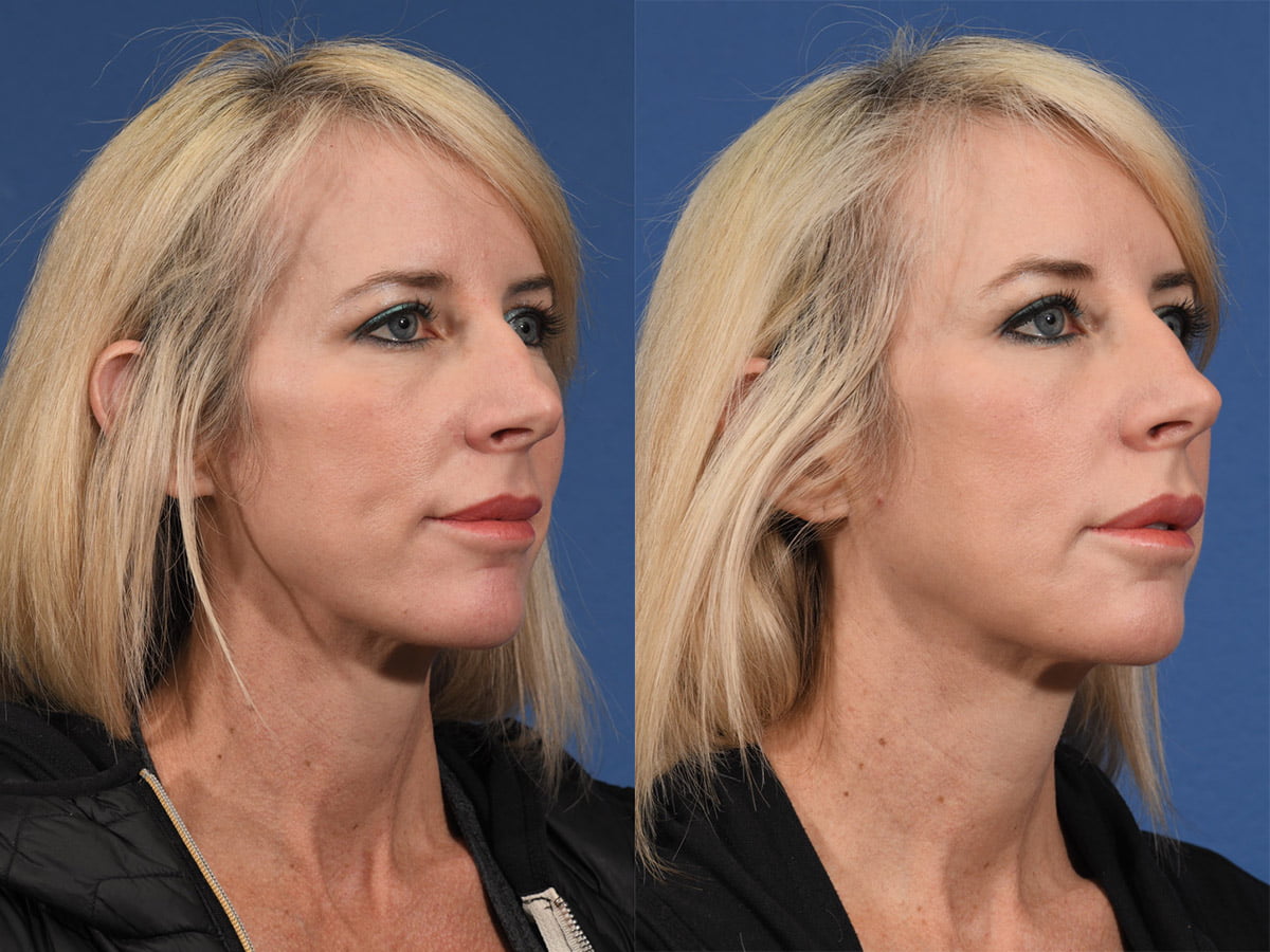 Injectables Before & After #7 image 3