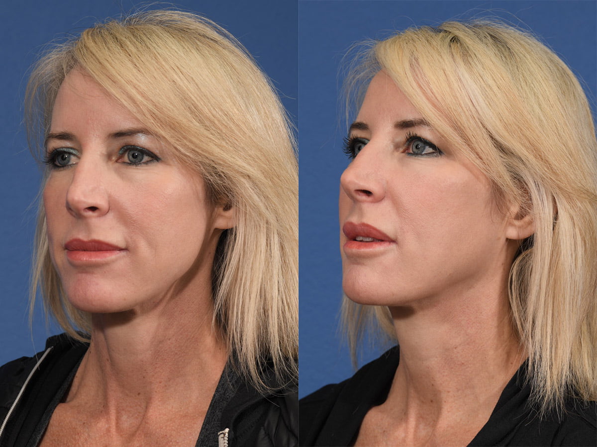 Injectables Before & After #7 image 4