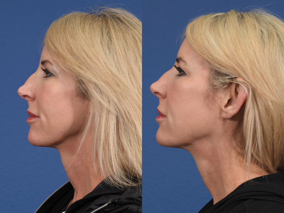 Injectables Before & After #7 image 5