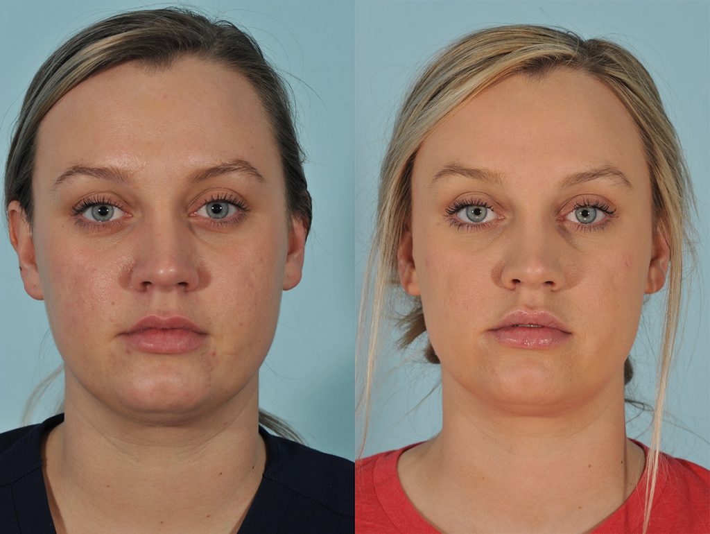 Injectables Before & After #8