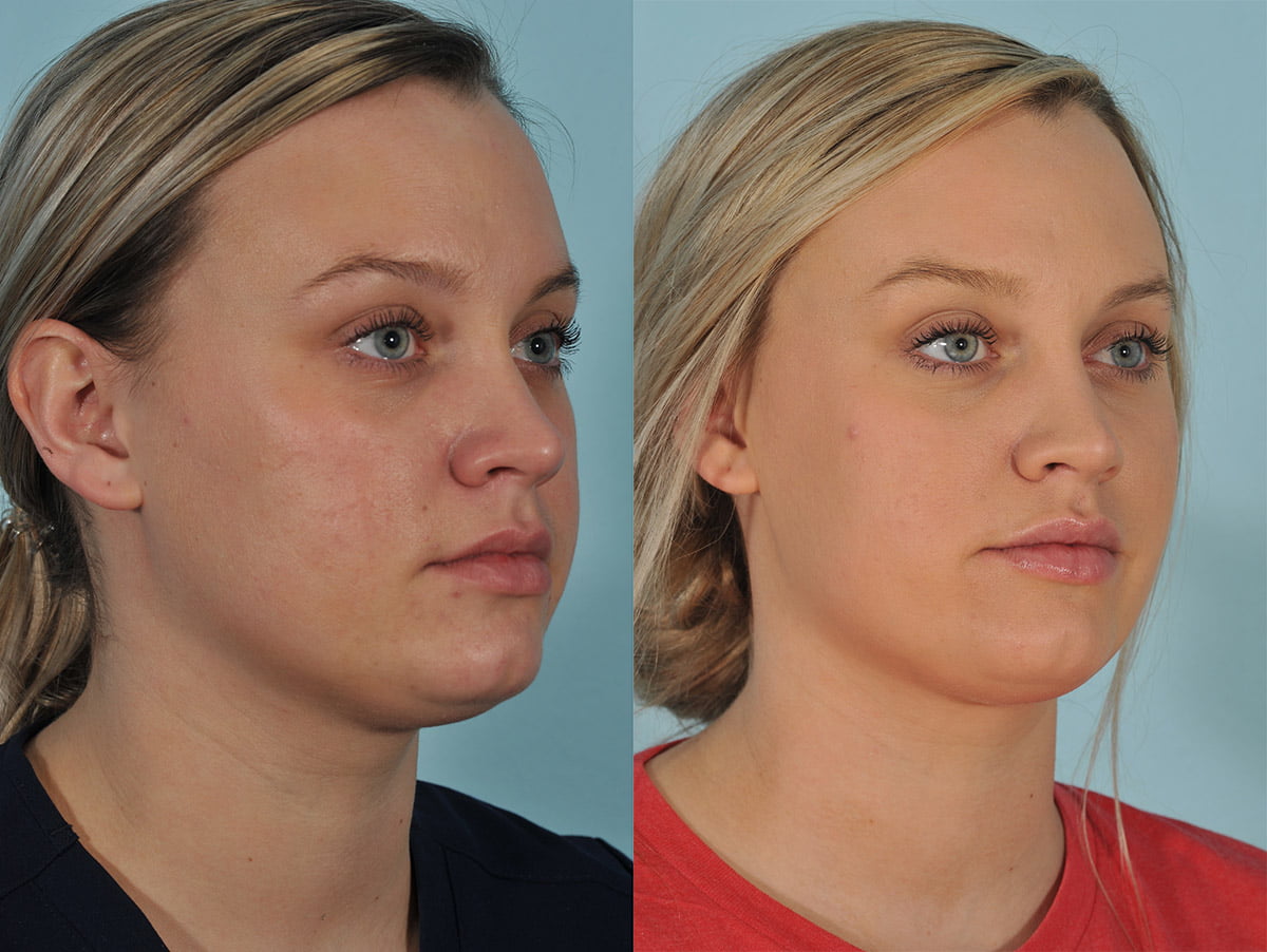 Injectables Before & After #8 image 2
