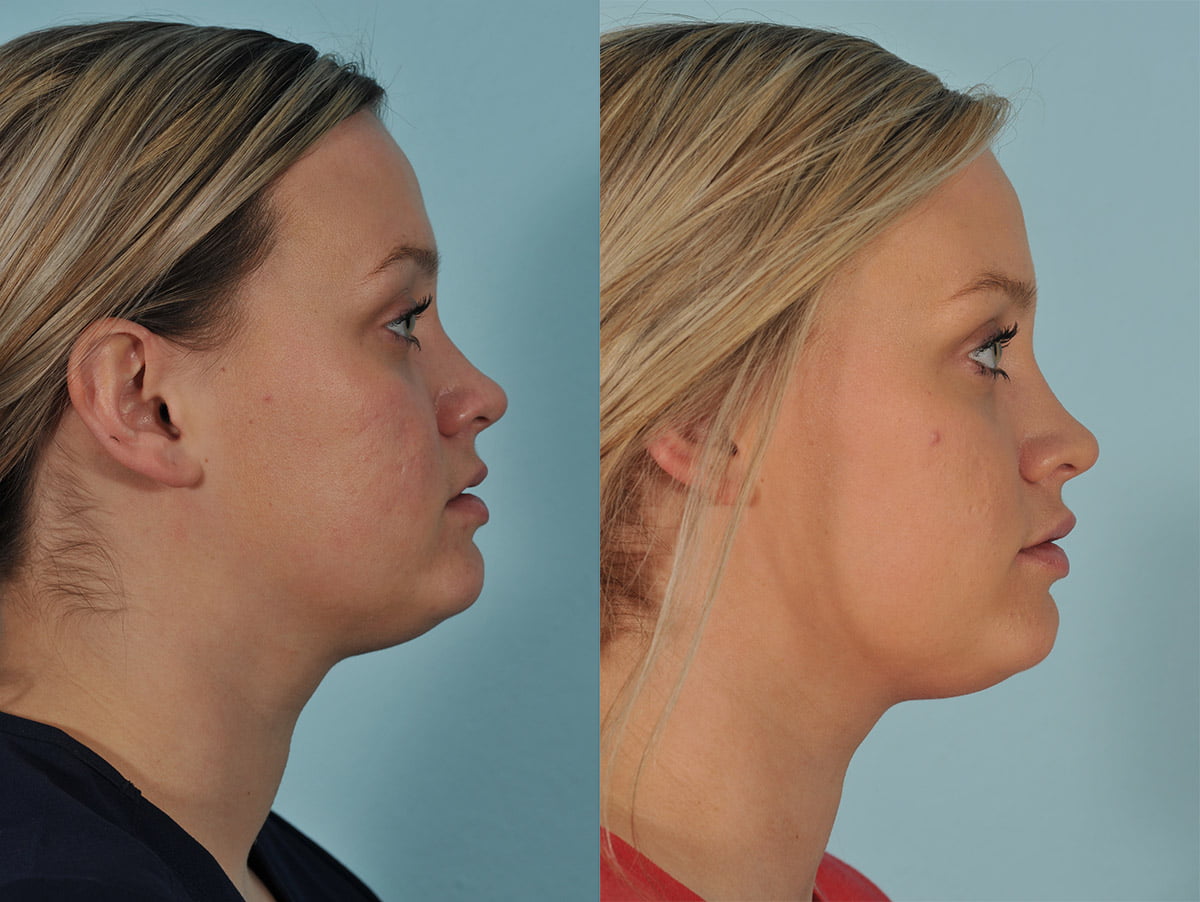 Injectables Before & After #8 image 3