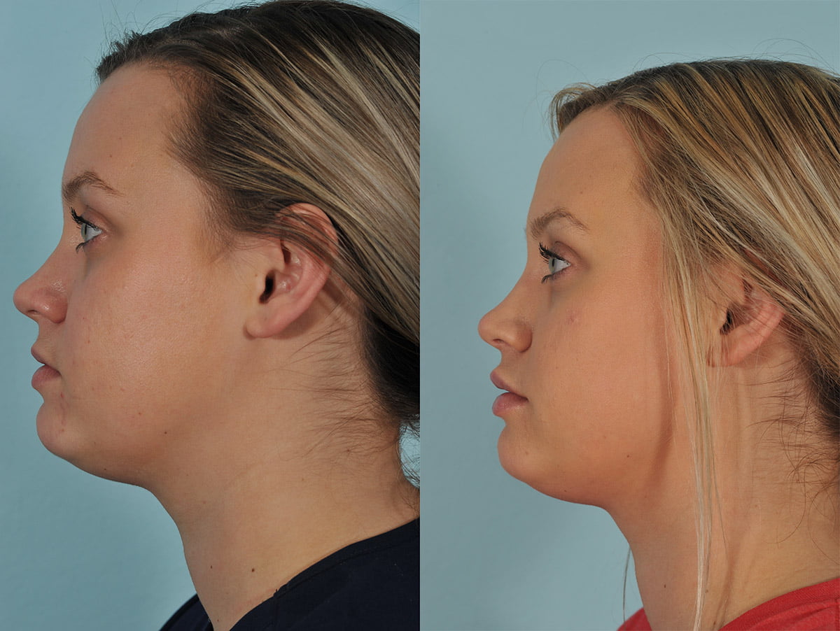 Injectables Before & After #8 image 4