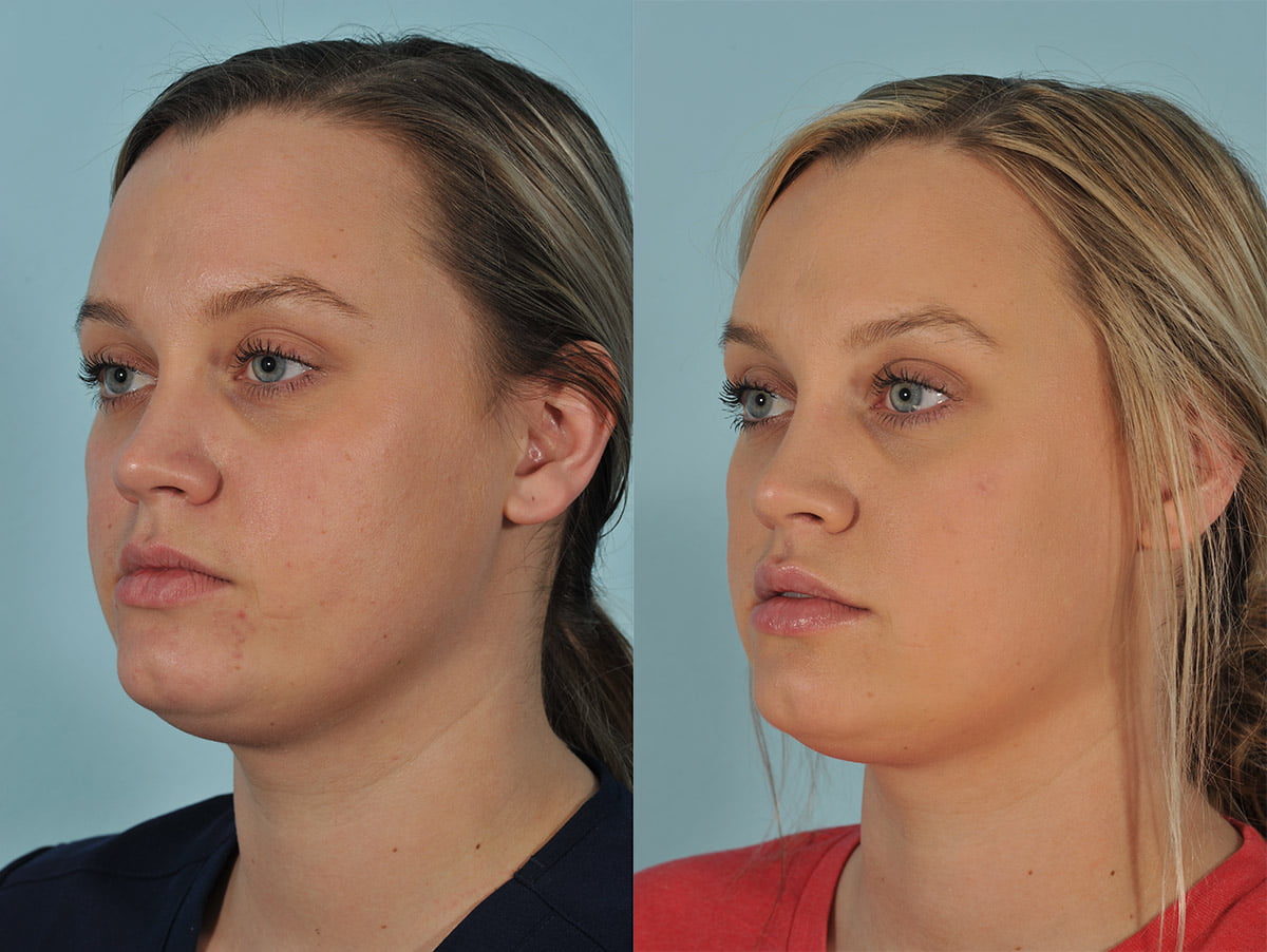 Injectables Before & After #8 image 5
