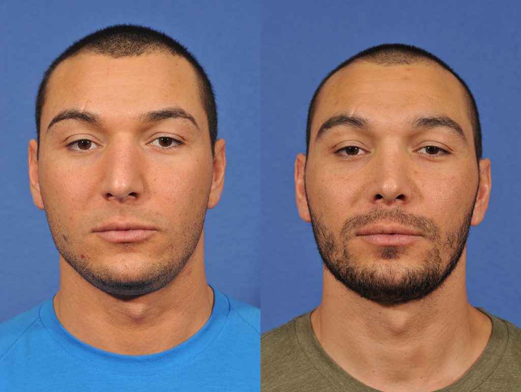 Rhinoplasty Before & After #12