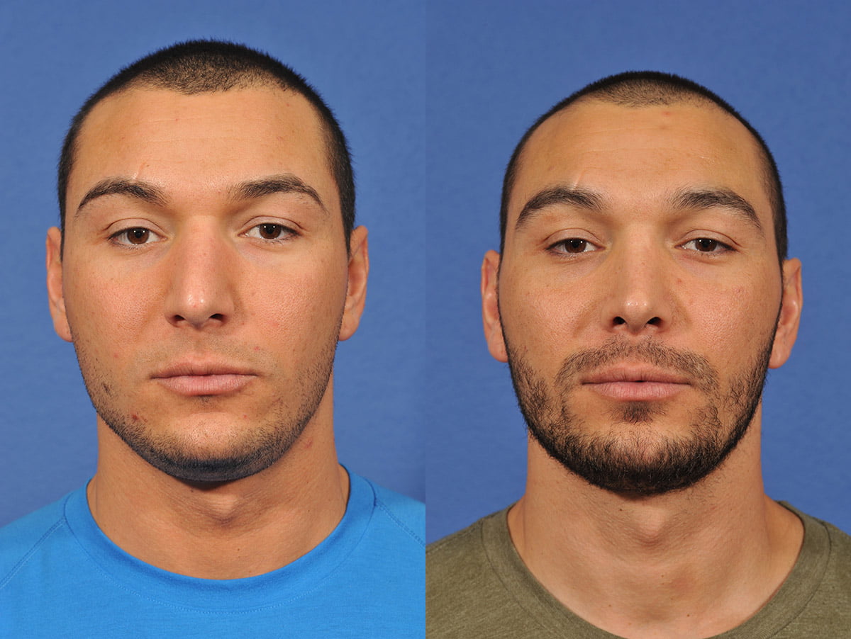 Rhinoplasty Before & After #12 image 1