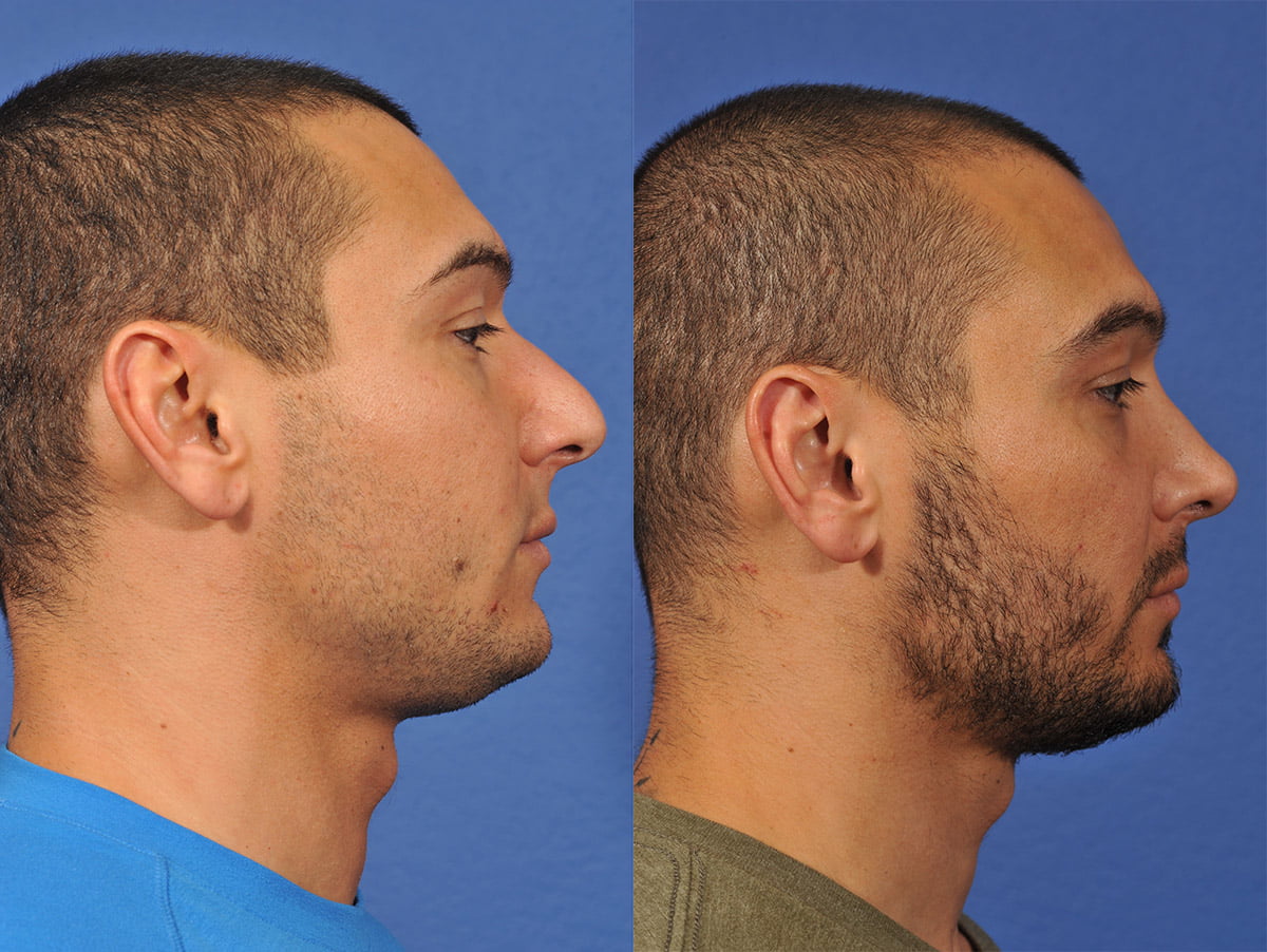 Rhinoplasty Before & After #12