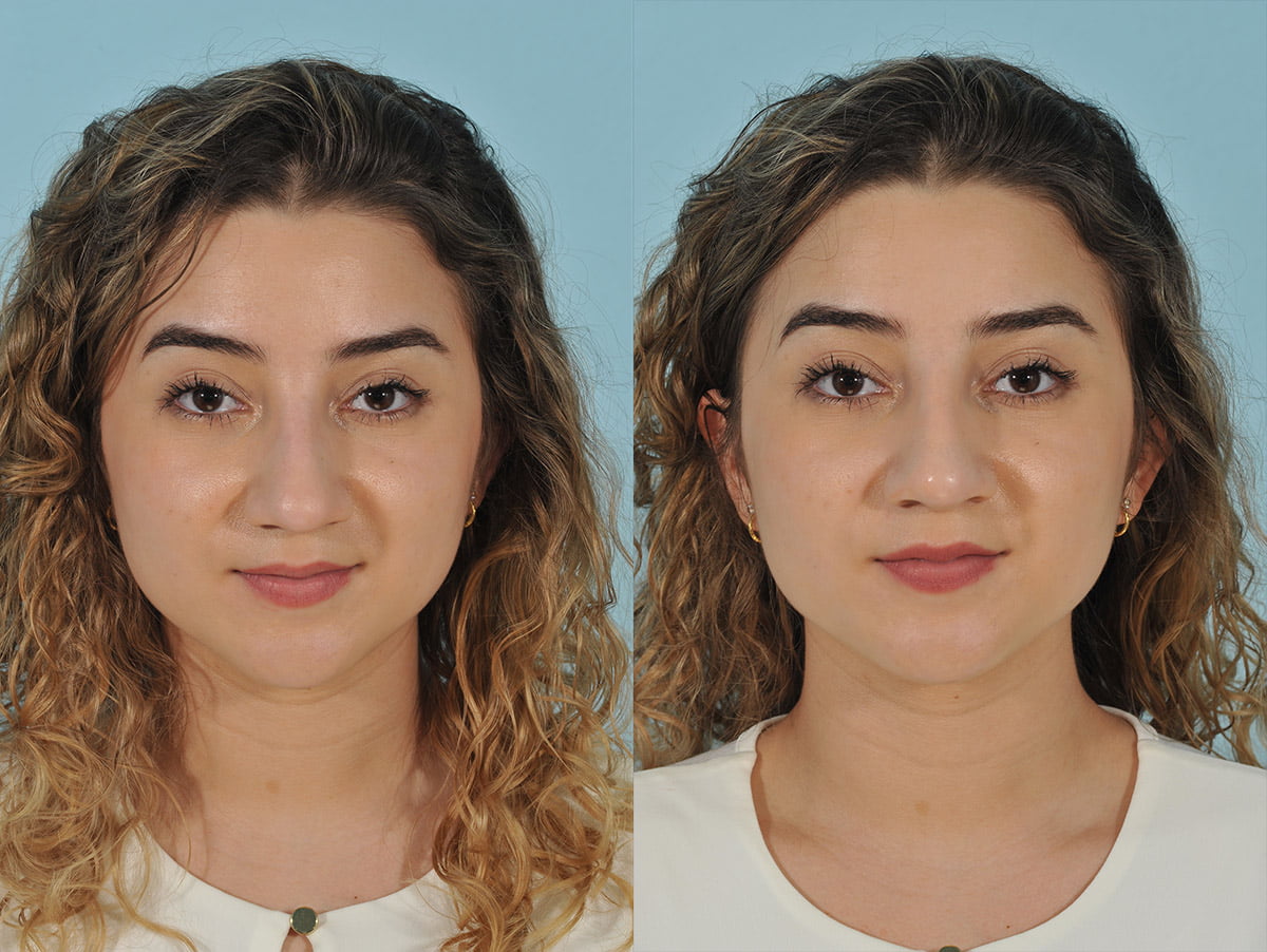 Injectables Before & After #9
