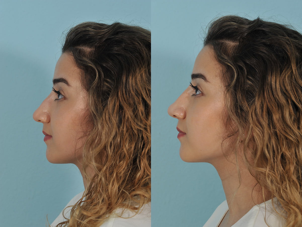 Injectables Before & After #9 image 3