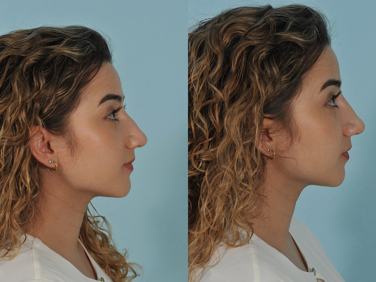 Injectables Before & After #9 image 2