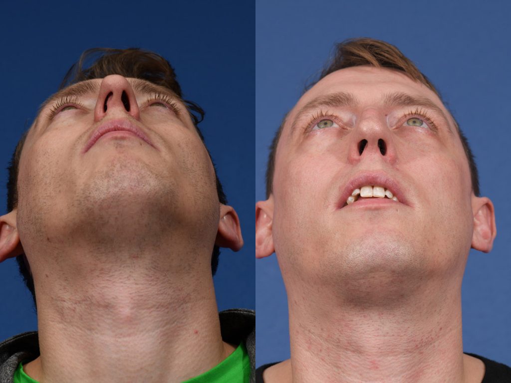 Rhinoplasty Before & After #13