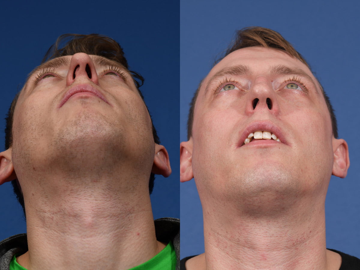 Rhinoplasty Before & After #13