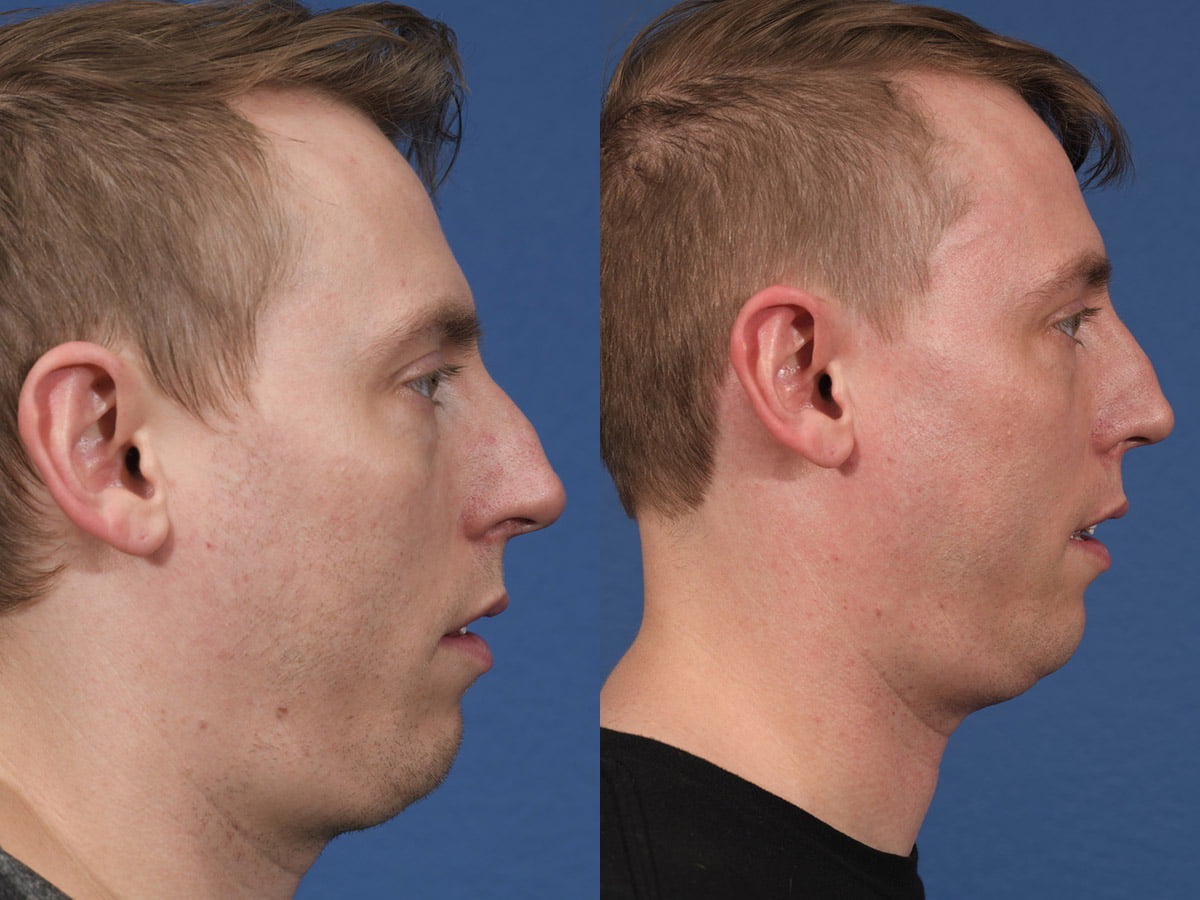 Rhinoplasty Before & After #13 image 3