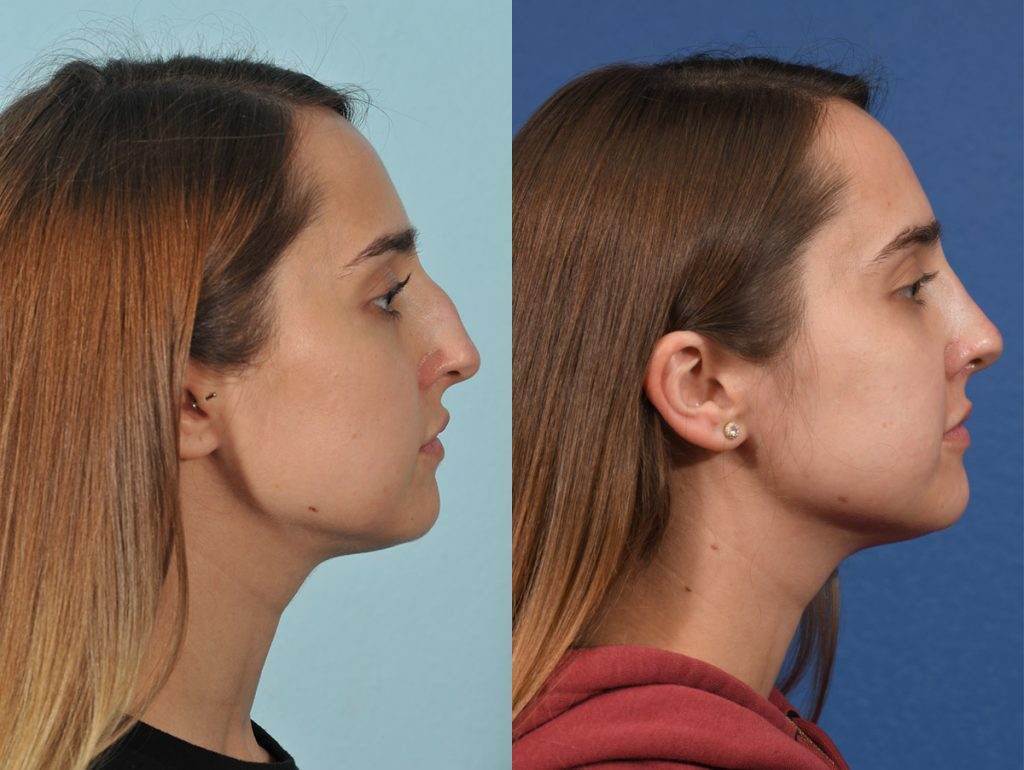 Rhinoplasty Before & After #14