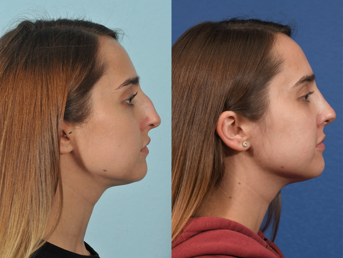 Rhinoplasty Before & After #14