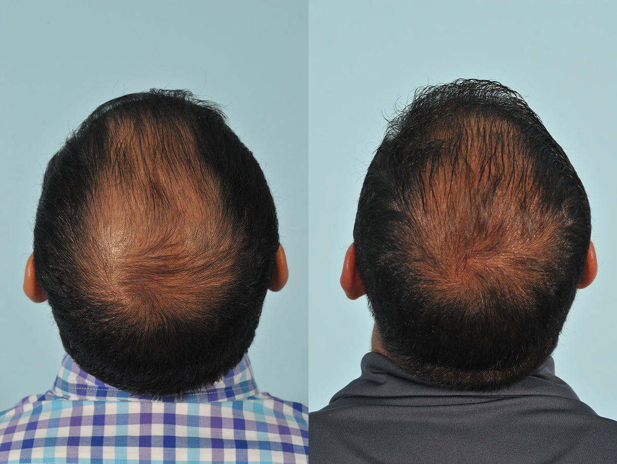 Hair Transplant Before & After #7 image 2