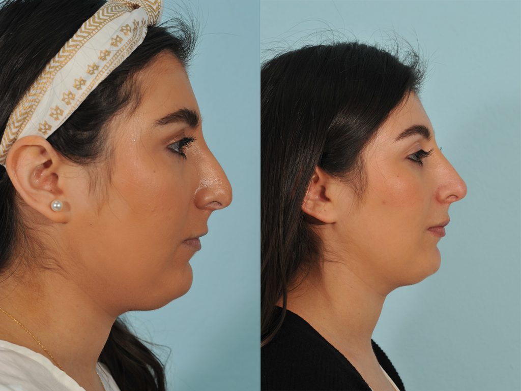 Injectables Before & After #10