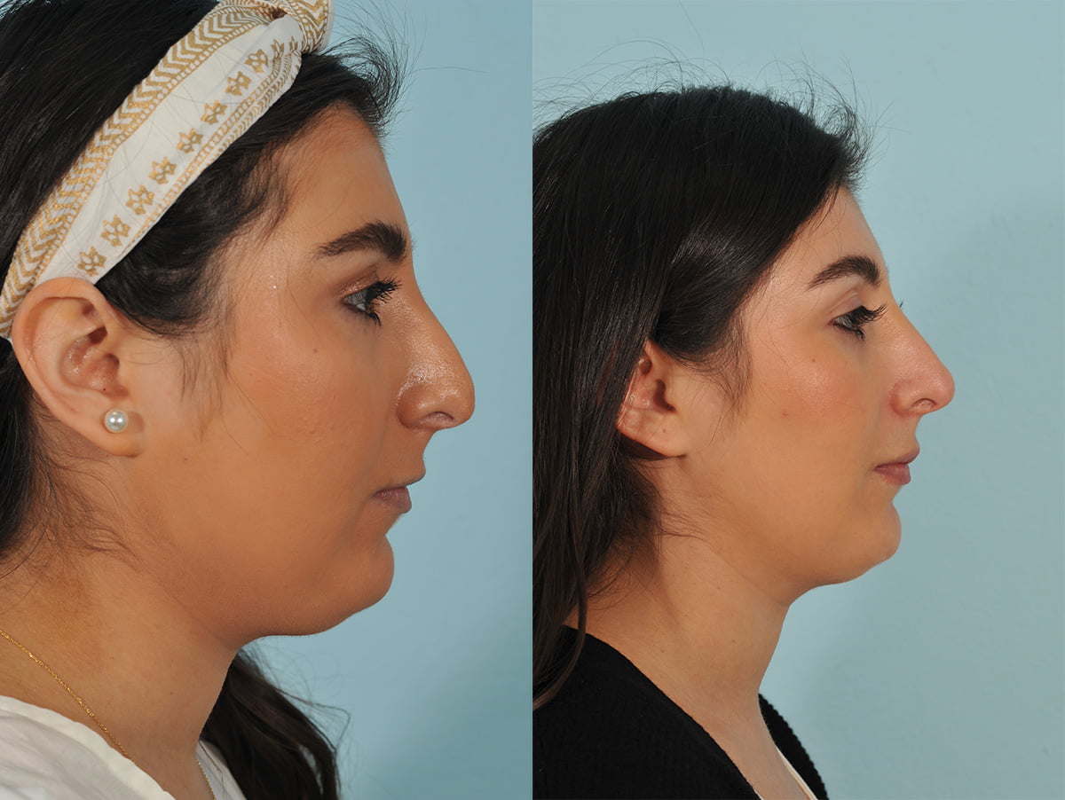 Injectables Before & After #10