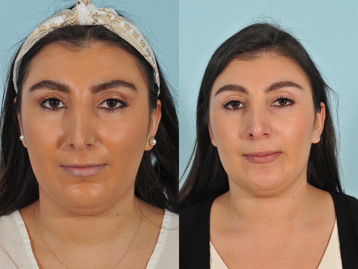 Injectables Before & After #10 image 2