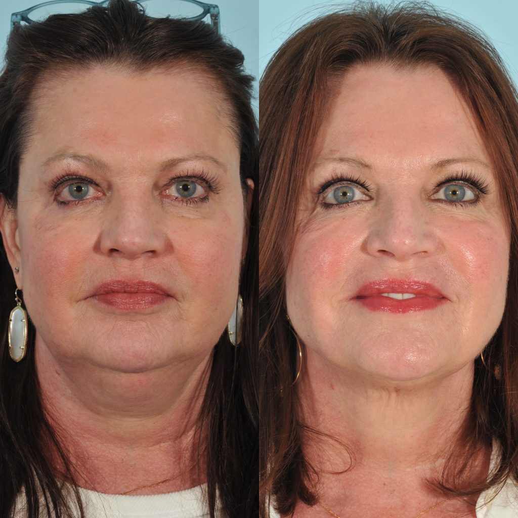 Kybella Before & After #3